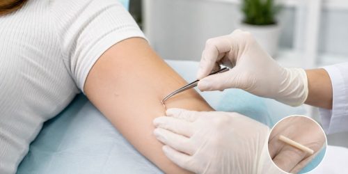 ICD-10 for Nexplanon Removal